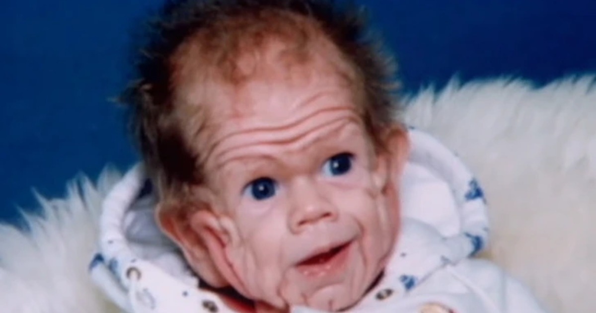 “Il bambino che ha stupito i medici con il suo raro disturbo”: come appare ora il ragazzo, 20 anni dopo?