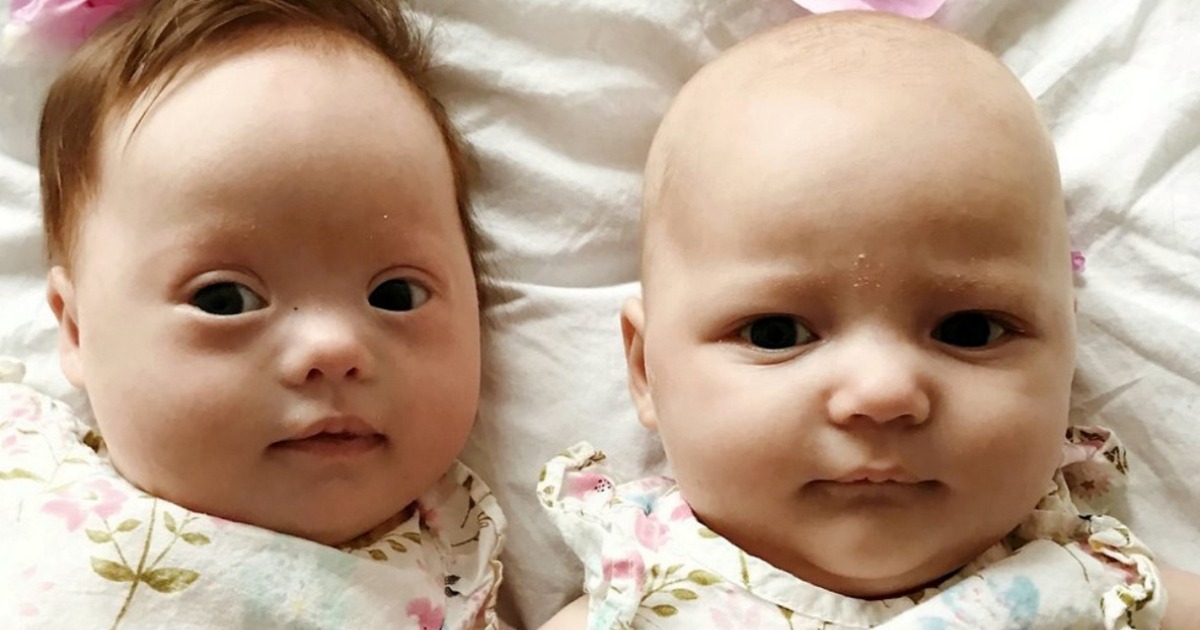 Gemelli con probabilità di 1 su un milione: uno ha la sindrome di Down, l’altro no!