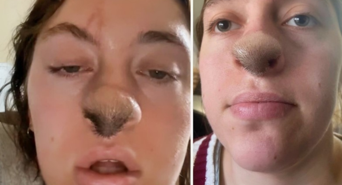 Morso di cane porta alla crescita di peli sul naso di una donna: la foto rivela un incredibile effetto collaterale!