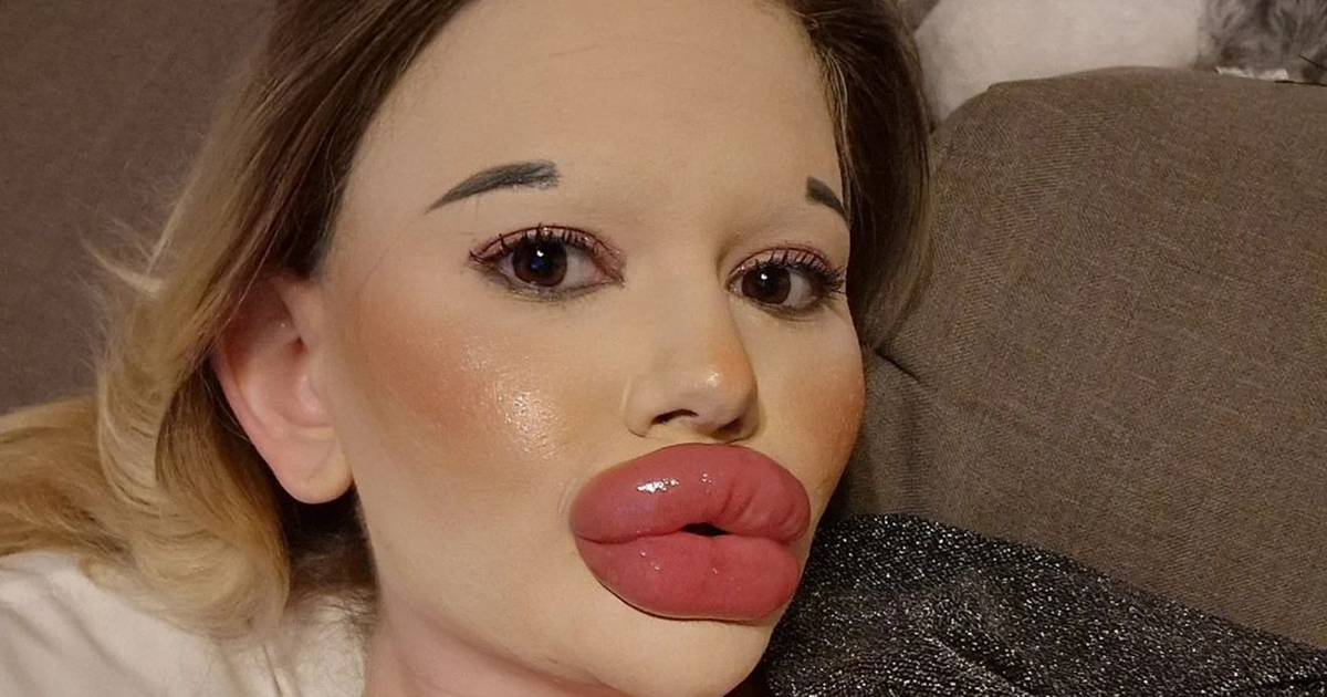 Ha solo 25 anni ma ha già fatto oltre 27 interventi: ora ha le labbra più grandi del mondo!