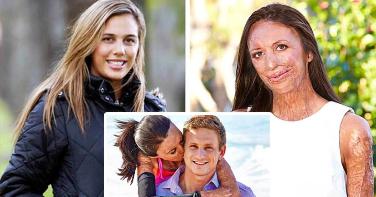 “200 interventi chirurgici e tre anni in ospedale”: la storia di una modella australiana che ha superato un terribile incendio e si è ripresa grazie al vero amore!