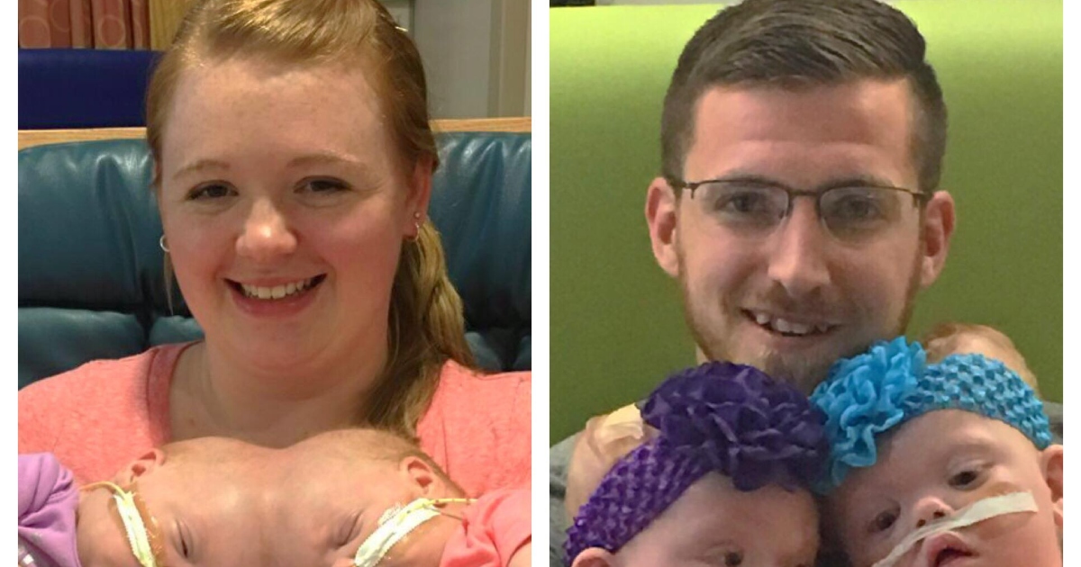 Le gemelle siamesi festeggiano la vita due anni dopo l’intervento: com’è la loro vita oggi?