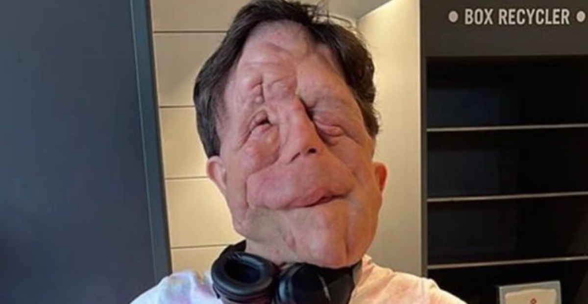 “La Straordinaria Storia di Adam Pearson”: L’Uomo dal Volto Unico che Ha Trasformato la Sua Condizione in una Missione di Vita